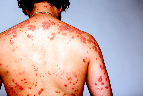 Thái Lan: Hơn 13.000 ca HIV mới trong nửa đầu 2025, thanh thiếu niên chiếm đa số